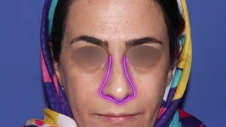 نتیجه قبل و بعد از جراحی بینی
