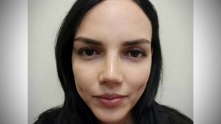 نمونه جراحی زیبایی بینی و چال گونه