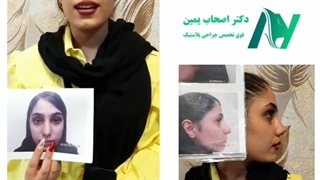 نمونه ای از جراحی رینوپلاستی