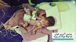 جراحی آترزی کوان دوطرفه نوزاد ۲روزه
