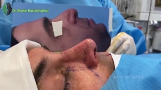 جراحی زیبایی بینی به فرم مردانه | دکتر باستانی نژاد | جراح بینی