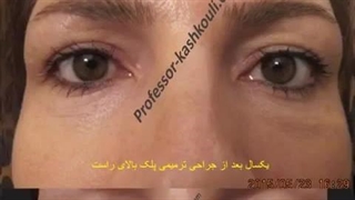 جراحی ترمیمی پلک بالای راست | پروفسور کشکولی | جراح پلک تهران