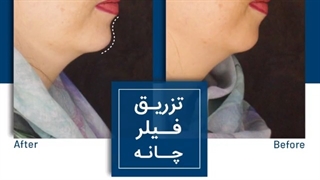 چانه میکرونیدلینگ