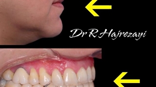 درمان ارتودنسی ثابت دو فک همراه با جراحی فک پایین | کلینیک تخصصی دندانپزشکی کانسپتا