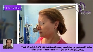فیلم واقعی جراحی لیفت کامل صورت و پیشانی