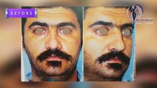 فیلم واقعی جراحی زیبایی بینی مردانه