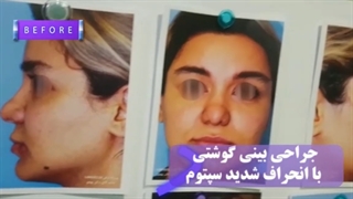 فیلم واقعی جراحی بینی گوشتی با انحراف شدید