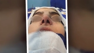 نمونه عمل زیبایى بینى دکتر على طاهری نیا برداشتن خال