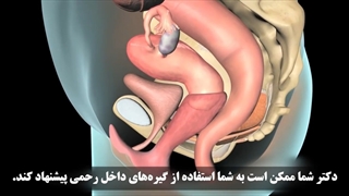 درمان موقت افتادگی رحم