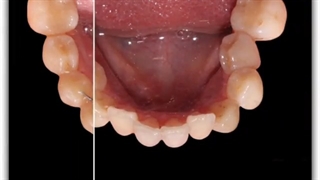 افزایش عرض قوس فکی | دکتر سعید قریشی