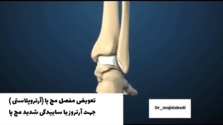 تعویض مفصل مچ پا