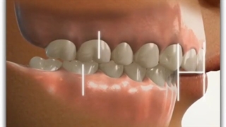 دستگاه ثابت فانکشنال (هر بست) | دکتر سعید قریشی