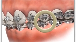 کش های ارتودنسی برای درمان اورجت | دکتر سعید قریشی