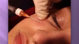 تزریق فیلر زیر چشم | دکتر سیدرضا رفیع | جراح پلاستیک
