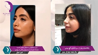 فیلم عمل بینی استخوانی