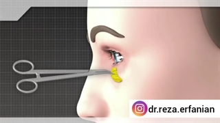 بلفاروپلاستی پلک تحتانی