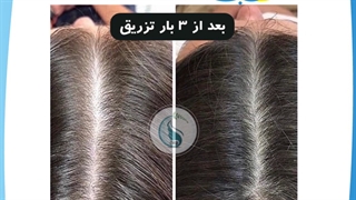 مزوتراپی پلاستیک لثه