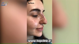 نتیجه جراحی بینی عقابی