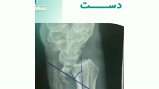 شکستگی و در رفتگی مچ دست
