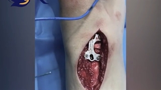 جراحی زانوى پرانتزى دو طرفه ژنوواروم و تصحیح توسط پلاک مینی