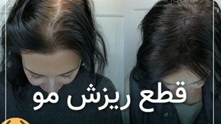 قطع کامل ریزش مو فقط با 3 جلسه مزوتراپی