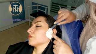 فیلم سابسیژن بهترین روش رفع جای جوش و آکنه