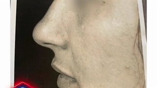 نمونه جراحی زیبایی بینی توسط دکتر احمد دانشی