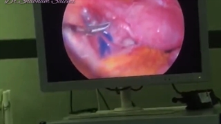لاپاراسکوپی هیدروسالپنکس همراه با آزاد کردن لوله