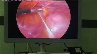 لاپاراسکوپی هیدروسالپنکس همراه با آزاد کردن لوله
