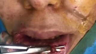 تخلیه ژل بیو پلیمر بعد از ۱۵ سال توسط دکتر ماریا مرادی