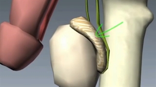 علت بروز ورم اپیدیمیت