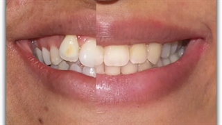 جایگزینی دندان نیش به جای دندان لترال | دکتر سعید قریشی