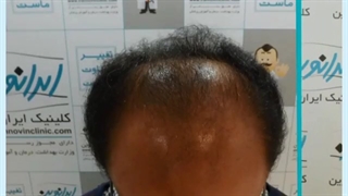 قبل و بعد کاشت