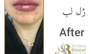 قبل و بعد از تزریق ژل لب