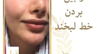 ازبین بردن خط خنده