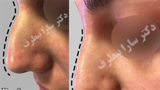 تزریق فیلر بینی