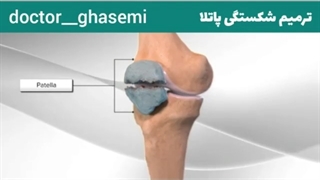 ترمیم شکستگی پاتلا