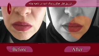 فیلم تزریق فیلر در چانه