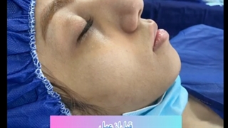 عمل بینی نیمه فانتزی