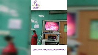 برداشت لوله حاوی هیدروسالپنکس قبل از ivf با لاپاراسکوپی