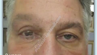 لیفت آندوسکوپی پیشانی ، بلفاروپلاستی افتادگی پلک چپ | پروفسور کشکولی