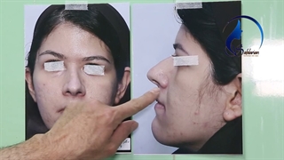 عمل بینی در اتاق عمل و نتیجه بعد از آن