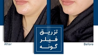 فیلر گونه کشیدن دندان