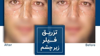 فیلر زیر چشم