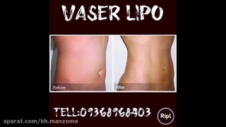 قبل و بعد از عمل لیپوماتیک