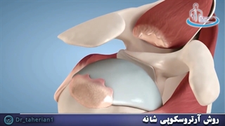 روش آرتروسکوپی شانه | متخصص ارتوپد | دکتر محمدابراهیم طاهریان