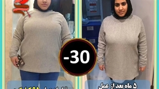 کاهش شگفت انگیز ۳۰ کیلویی وزن با لیپوماتیک