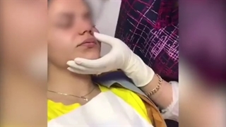 تزریق ژل لب با بی حسی