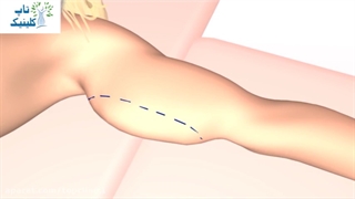 چگونگی انجام جراحی لیپوماتیک بازو