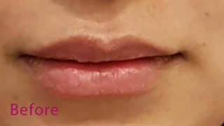 فیلر لب مدل میکس روسی و حجمی
